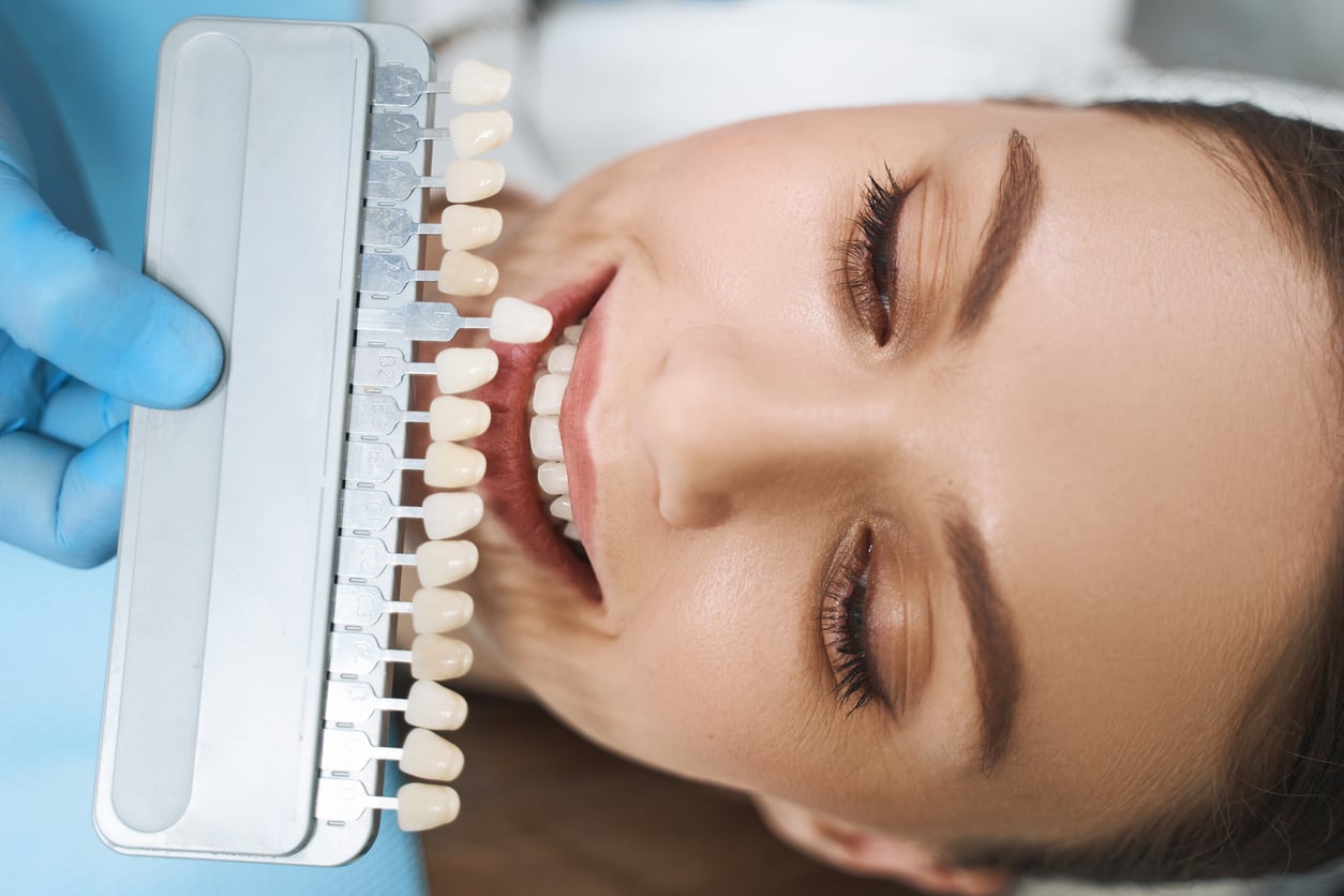 What Are Dental Veneers